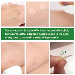 Acne Pimple Patch Sticker Acne Treatment Pimple Remover - Vita Luxe Skin Care 